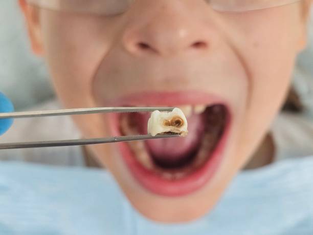 Best Emergency Treatment for Toothache in Jonesboro, GA